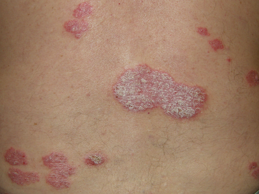  Chronic plaque psoriasis