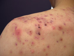 Severe acne