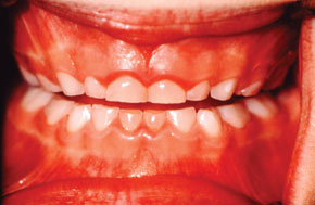 gingivitis