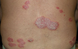 Palaque psoriasis