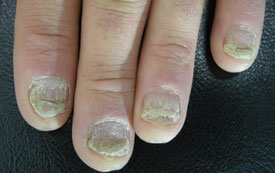 Nail psoriasis