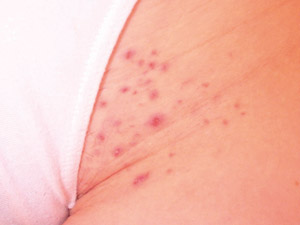 Folliculitis