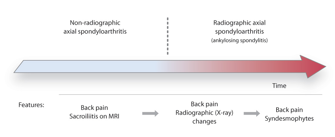 Axial spondyloarthritis